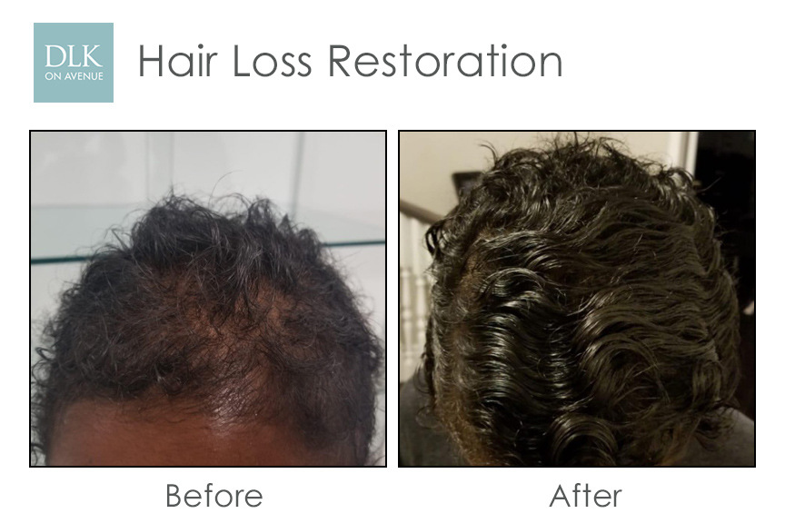 Before and After Photos Hair Loss Restoration with PRP-1