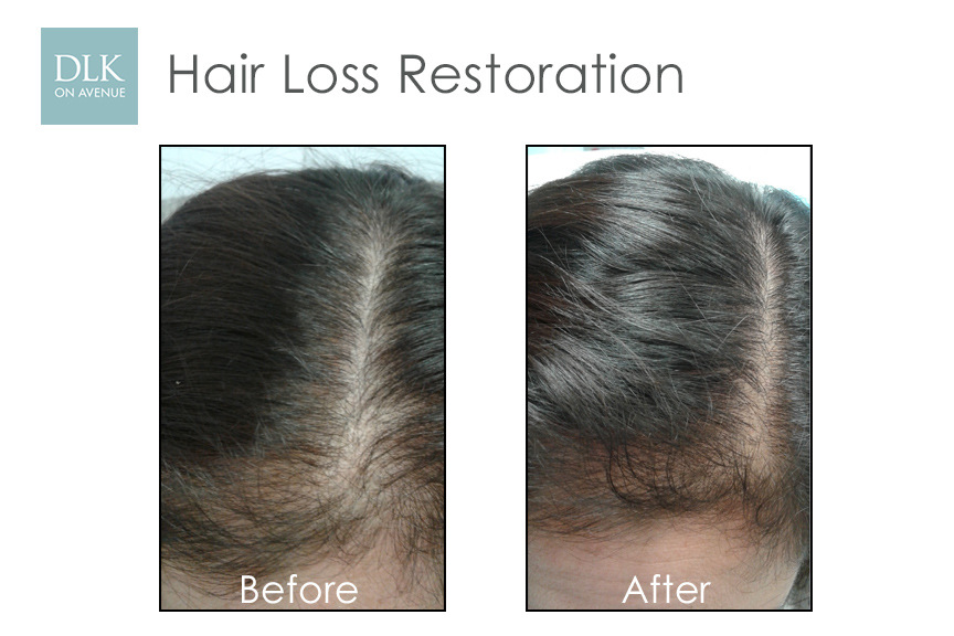 Before and After Photos Hair Loss Restoration with PRP-2