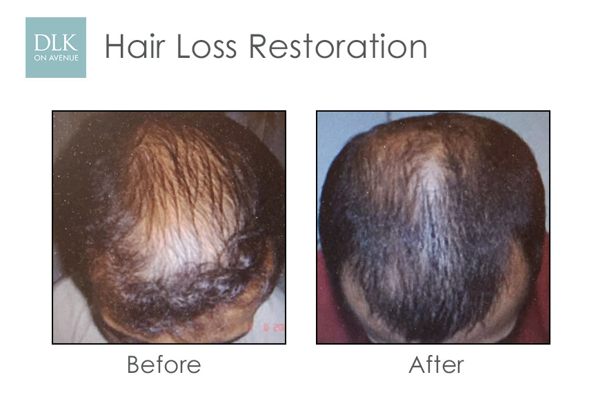 Before and After Photos Hair Loss Restoration with PRP-3