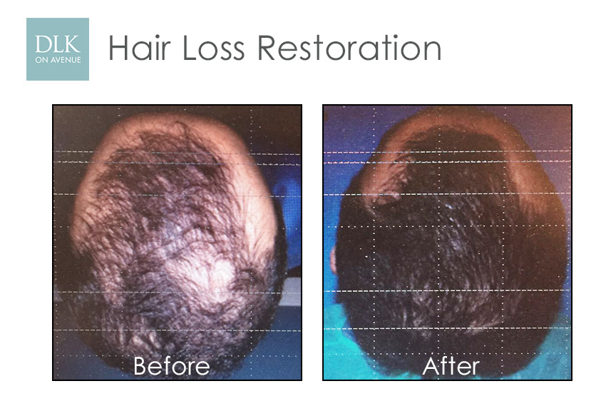 Before and After Photos Hair Loss Restoration with PRP-4
