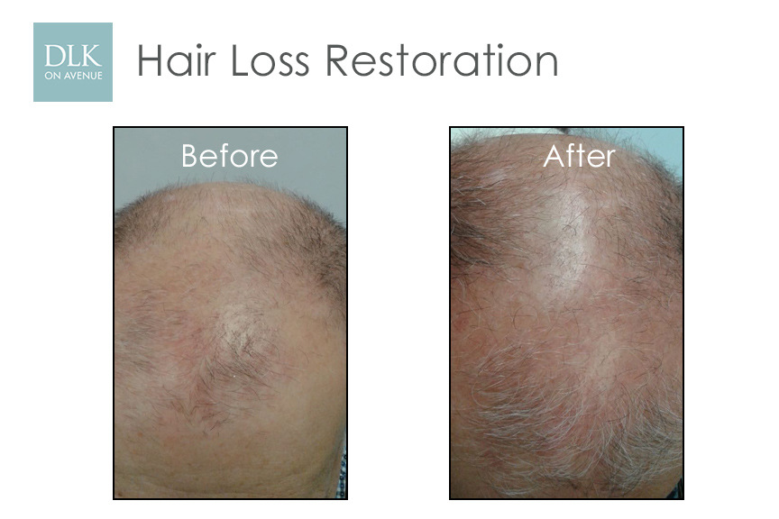 Before and After Photos Hair Loss Restoration with PRP-5