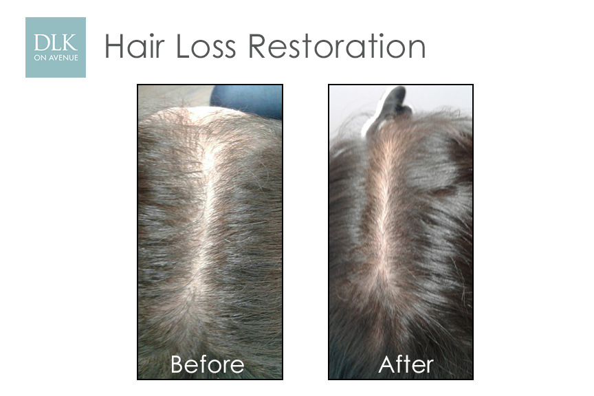 Before and After Photos Hair Loss Restoration with PRP
